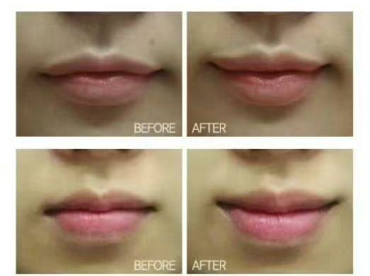 三、土豆片能改善眼袋浮肿吗?