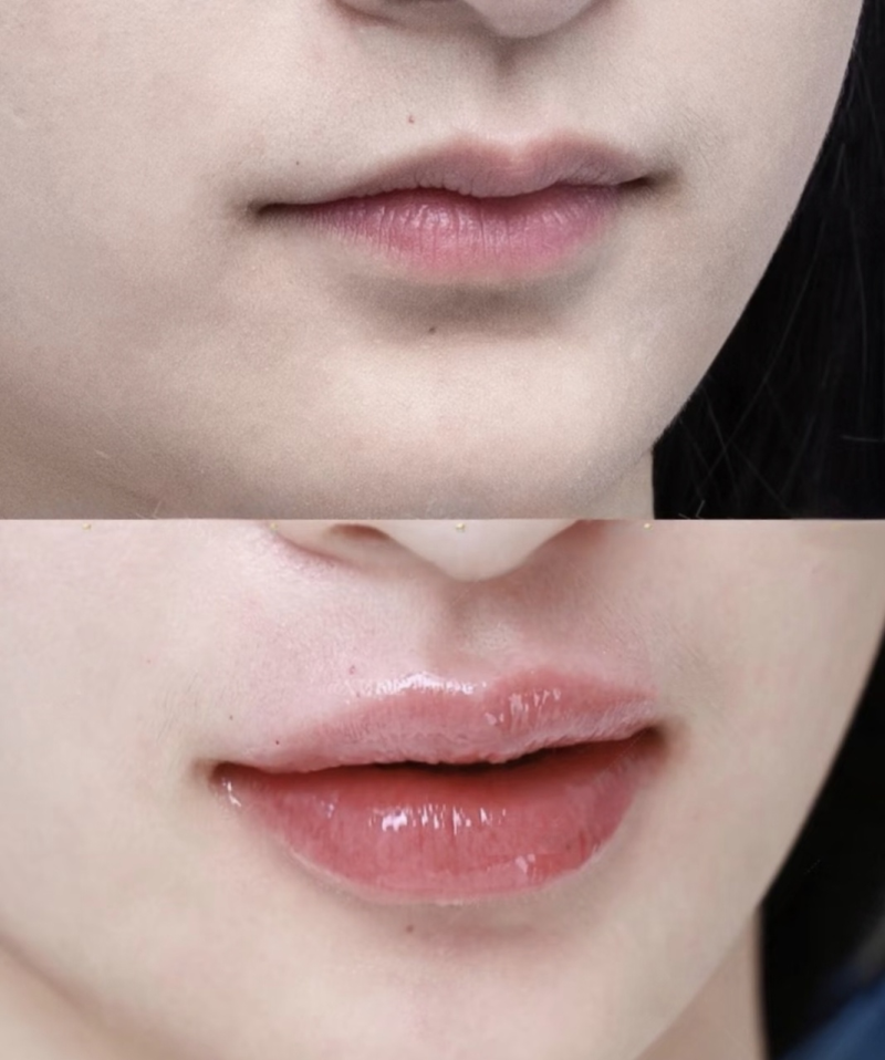 四、个性化定制：放大成效需结合眼部基础