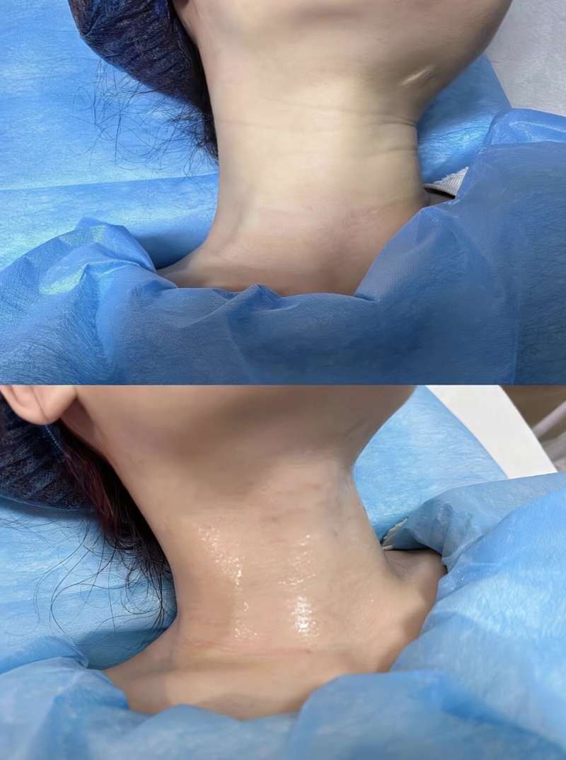 六、术后9个月-1年：更终稳定成效，头发完全定型