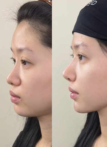 四、眼袋术后加快疤痕消失的护理核心要点