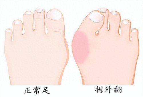 四、内双眼皮到底是什么眼睛?