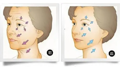 三、共振吸脂后多久可以运动？科学活动助力修复