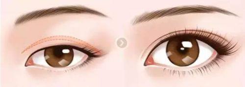 小孩额头缝针疤痕怎么消除？能不能去掉、擦啥药膏、日常修复方法全解析