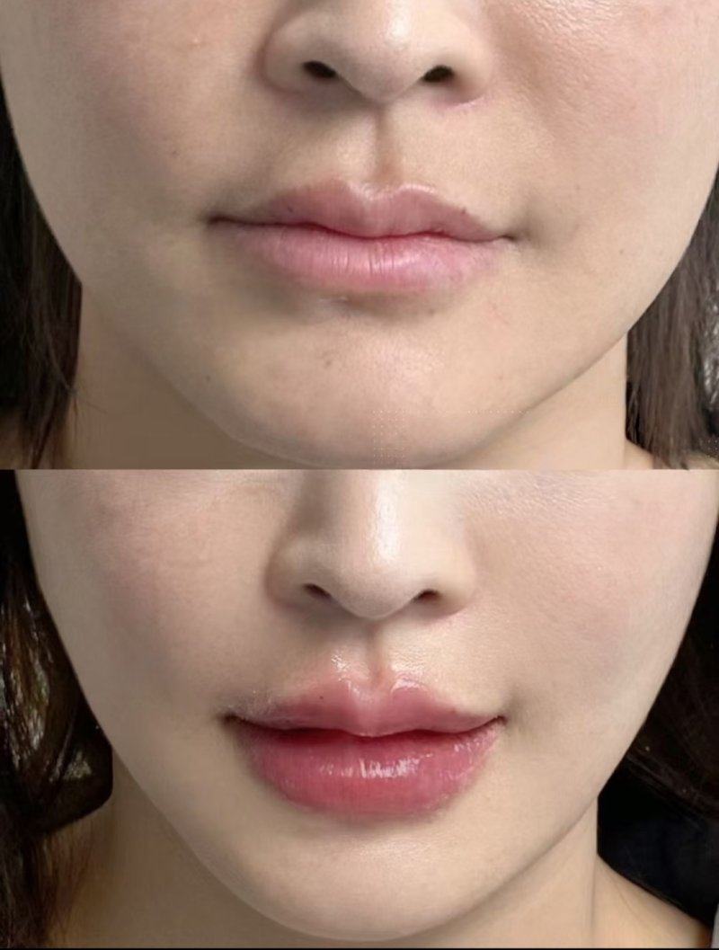 三、小孩额头缝针疤痕擦什么药膏好