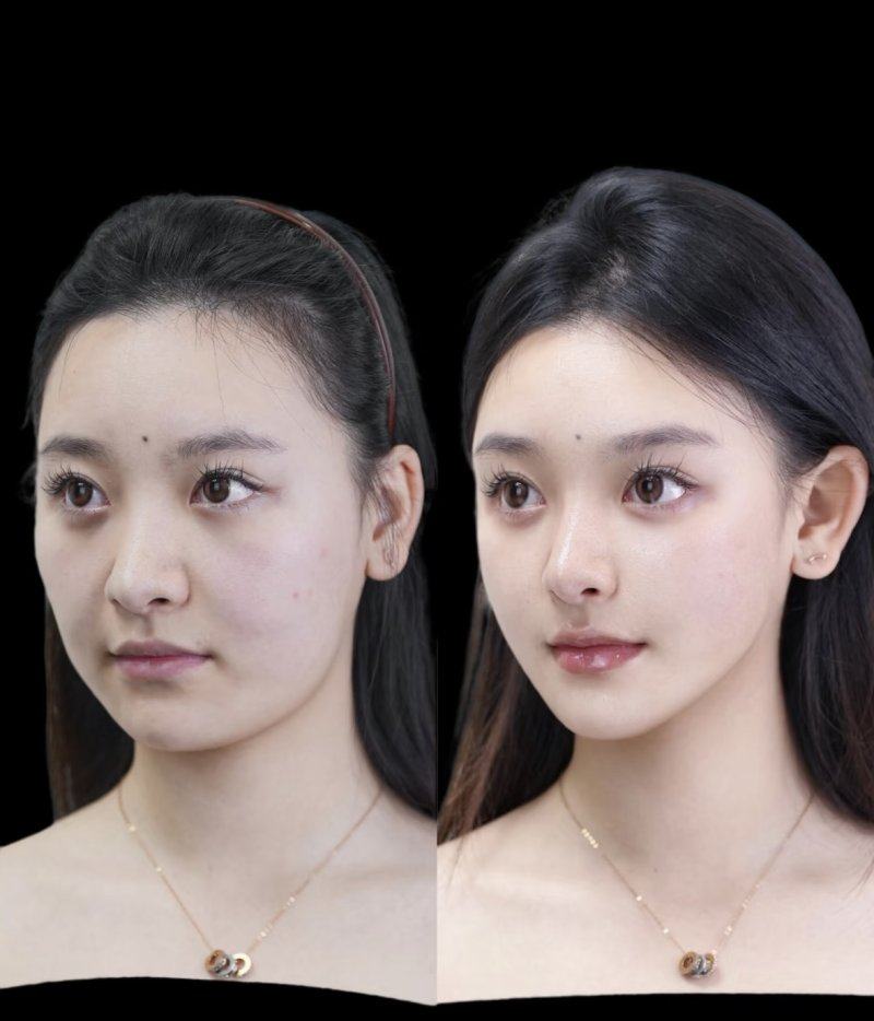 五、小孩额头缝针疤痕的专精治疗选择