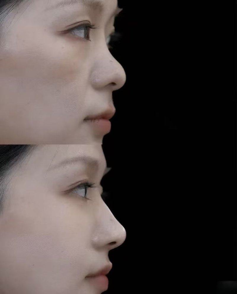 五、隆胸后能做剧烈运动吗?