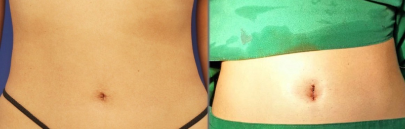 五、燕郊做双眼皮前，这些准备事项要牢记