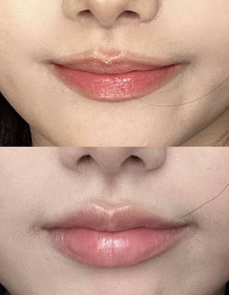 二、抽脂手术的重度风险副作用