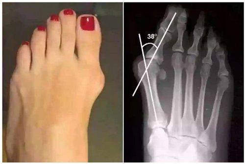 三、打了瘦脸针多久能达到成效高峰期