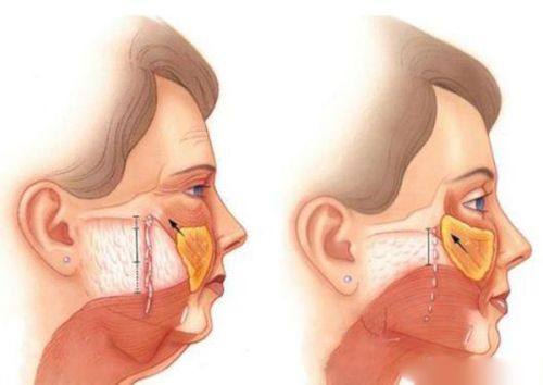 四、风险定性差异:磨骨被明确列为高风险手术