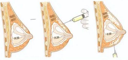 二、翘睫双眼皮和普通双眼皮的核心区别