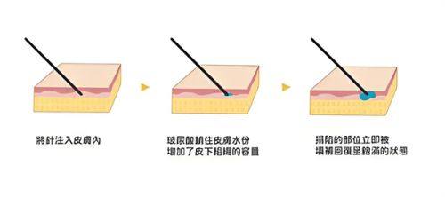 二、从手术等级与操作复杂度看:磨骨风险基数远高于隆胸