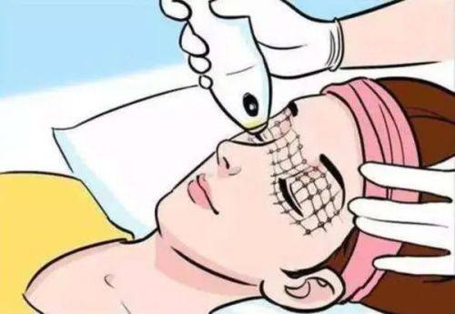 四、翘睫双眼皮是埋线还是全切?需结合技术与自身需求选择