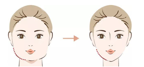 三、疤痕平整却反光是怎么回事