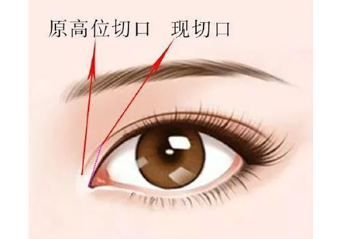 五、为什么现在不推荐打韩国粉毒瘦脸针?