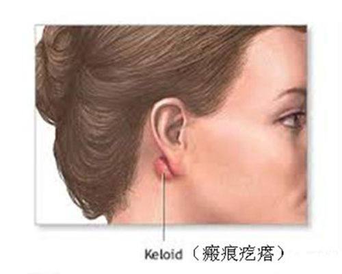 四、双眼皮肿成单眼皮好多天了该怎么处理