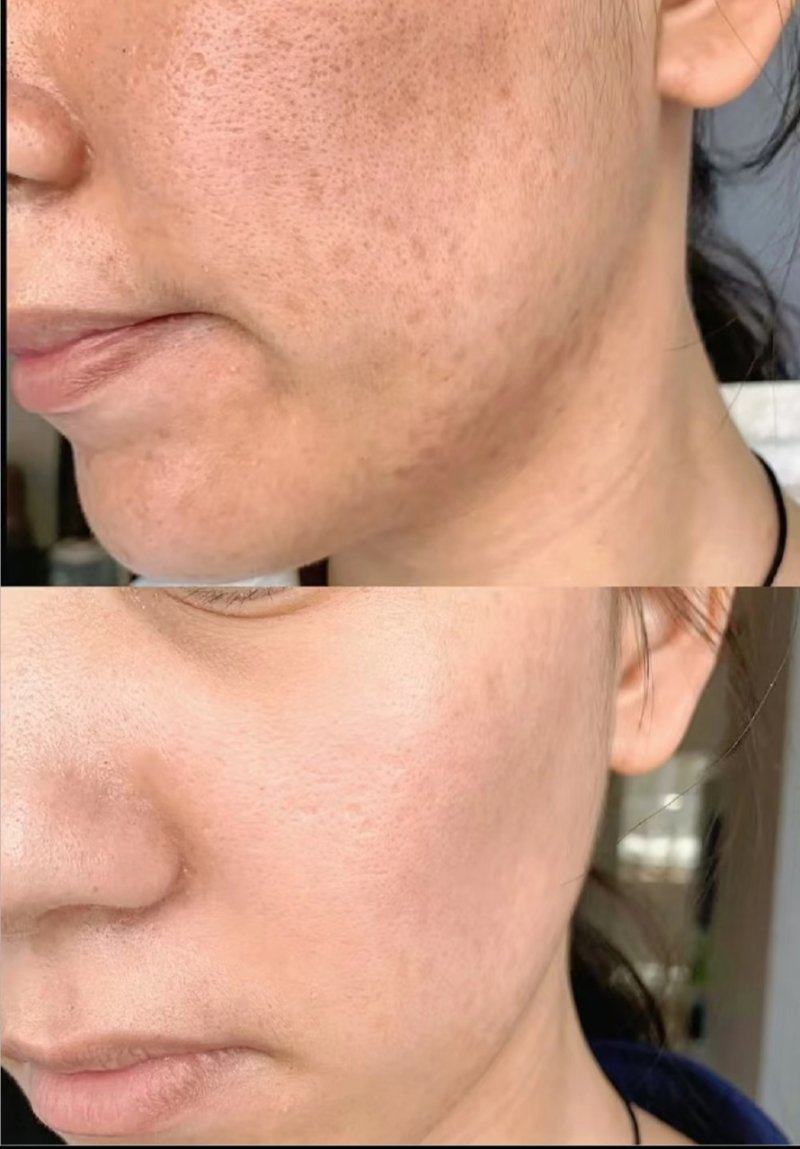 四、疤痕反光修复的关键护理要点