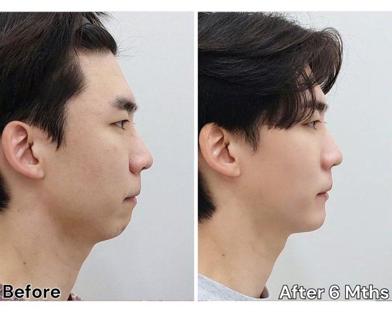 二、否认方的核心回应:双眼皮贴的解释