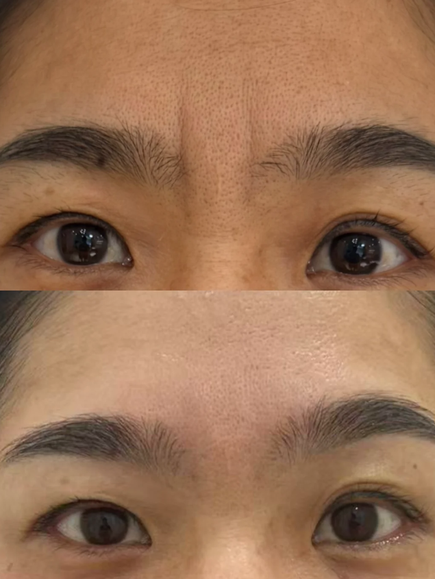 二、术后6个月内（修复期）：观察+护理，多数不对称可自然改善