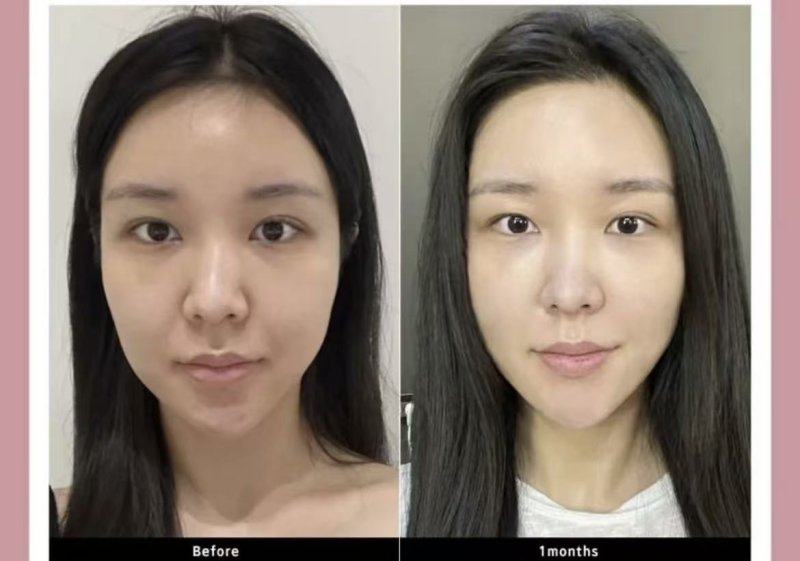 三、韩国粉毒瘦脸针安心吗?有没有副作用?