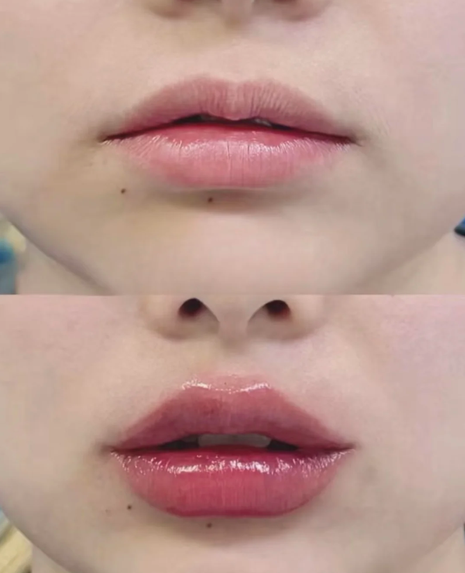 四、双眼皮手术价格参考与避坑要点