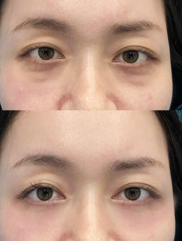 六、如何判断瘦脸针是否开始起效