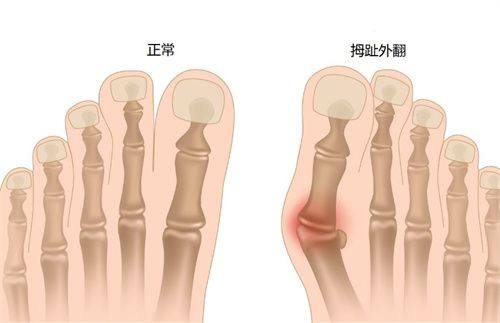 五、加速大腿抽脂术后修复的核心护理细节