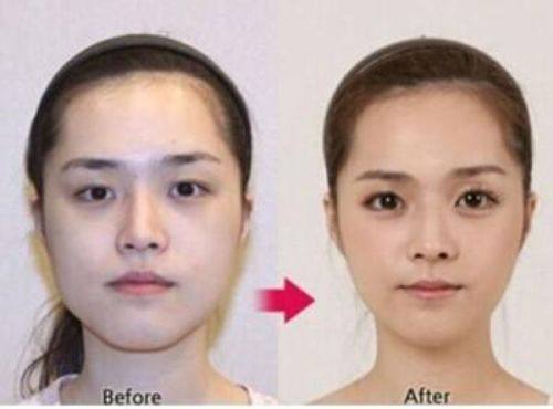 四、甲状腺手术后疤痕怎么去除（针对顽固性/成熟期疤痕）