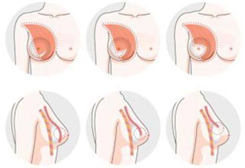 五、影响自体脂肪隆胸变软速度的核心因素