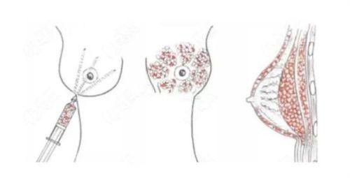 四、陈旧性突出疤痕（如下巴疤痕）：分阶治疗，早干预成效好