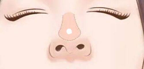 二、疤痕疙瘩目前更有效的治疗方案——SRT-100浅层放射治疗