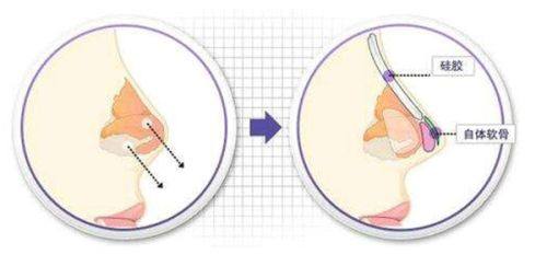二、甲状腺手术疤痕怎么消除更快