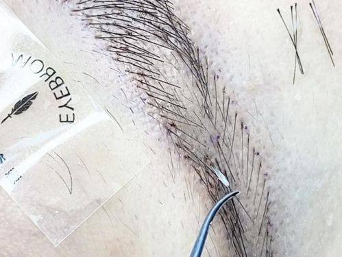 邓飞艳医生技术优势