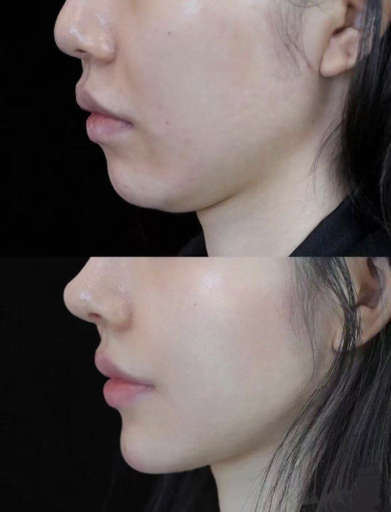 三、甲状腺手术疤痕怎么淡化