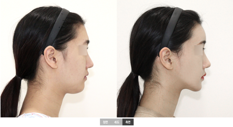 四、隆胸修复期：揉捏的核心禁忌不能碰