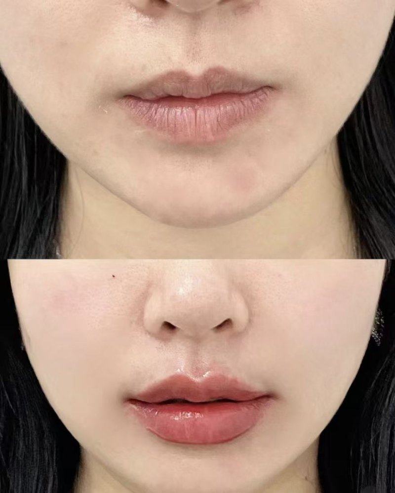 四、面部凹陷后的修复:多数可逆,特殊情况需警惕