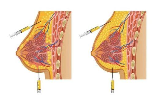 二、正规操作下的短期轻微不良反应