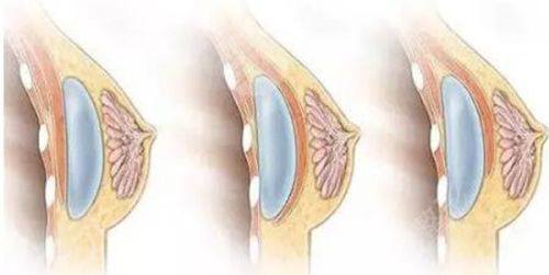六、假体隆胸术后专项注意事项：饮食、睡姿等细节不能少