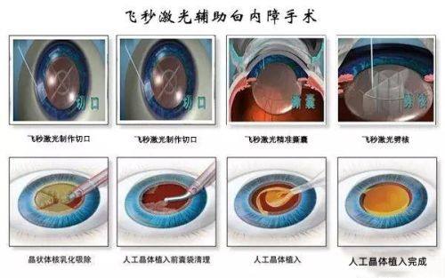 二、宝俪隆胸1个月的真实手感反馈