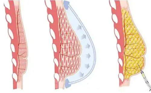 四、影响宝俪隆胸变软速度的其他关键因素
