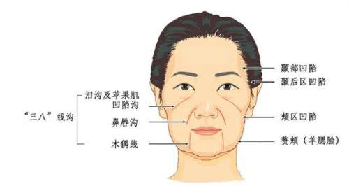 全切双眼皮的疤痕多久消失？分3阶段1-6个月淡化，护理+技术加速隐痕