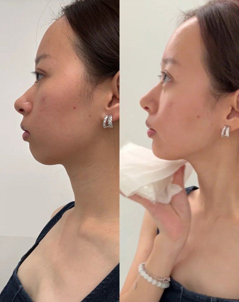 二、凹凸疤痕怎样祛除更有效