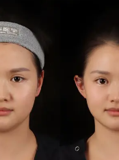 二、额头上凹陷疤痕的修复小妙招