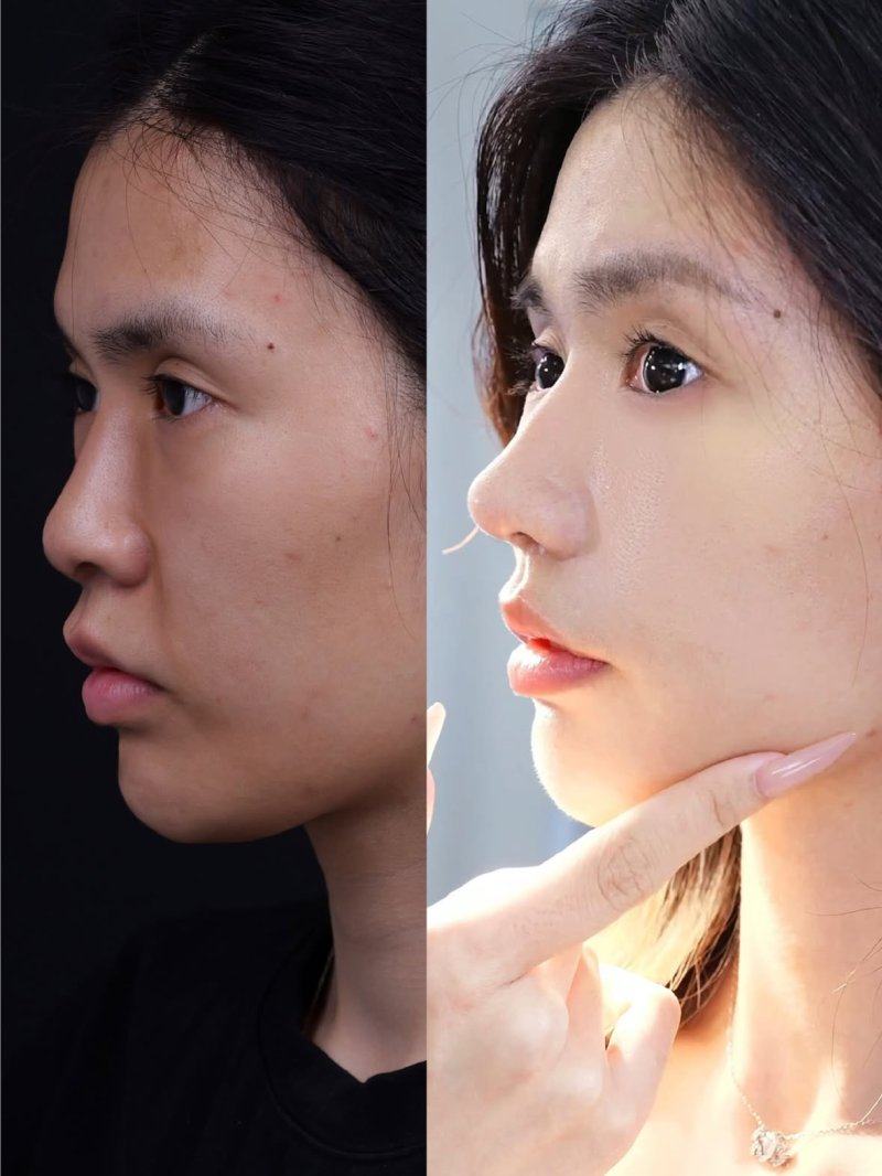 二、术后0-2周黄金静养期：以伤口愈合与假体固定为核心