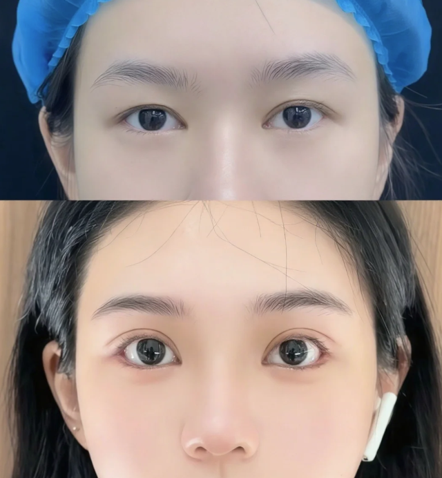 三、疤痕疙瘩治疗全周期护理关键要点