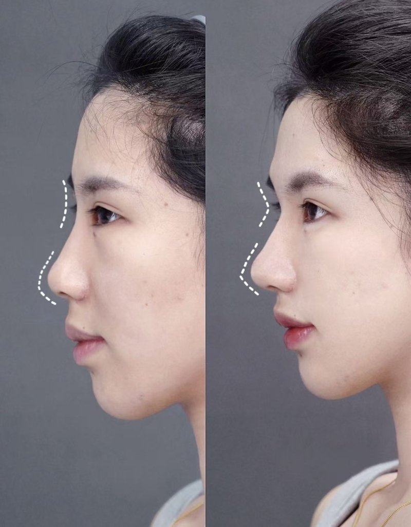 三、假体类型对宝俪隆胸变软速度的影响