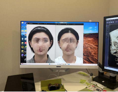 五、日常防护:避免凹凸疤痕“雪上加霜”