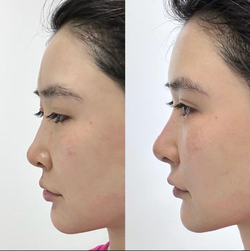 三、手术治疗：重度/顽固性增生疤痕的有效方案