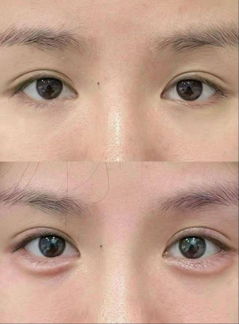 五、宝俪胸假体价位参考及选择建议