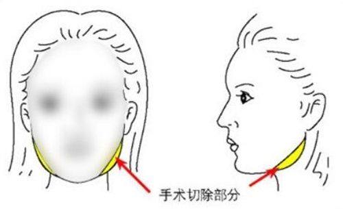 三、细胞激活祛眼袋的具体改善方法